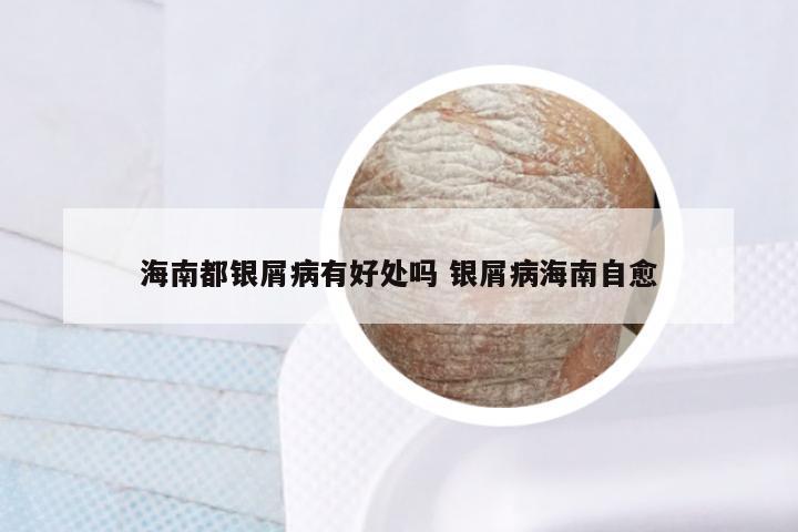 海南都银屑病有好处吗 银屑病海南自愈
