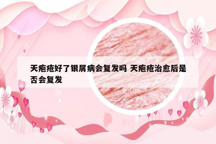 天疱疮好了银屑病会复发吗 天疱疮治愈后是否会复发
