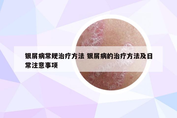 银屑病常规治疗方法 银屑病的治疗方法及日常注意事项
