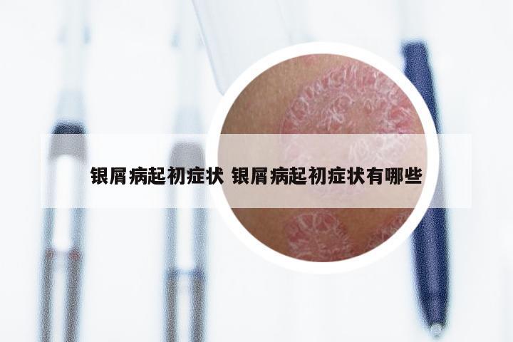 银屑病起初症状 银屑病起初症状有哪些