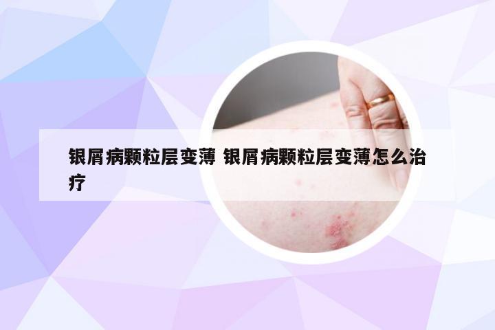 银屑病颗粒层变薄 银屑病颗粒层变薄怎么治疗
