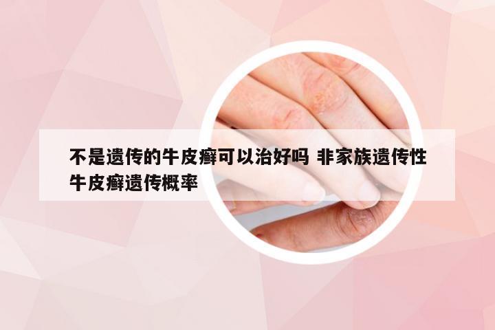 不是遗传的牛皮癣可以治好吗 非家族遗传性牛皮癣遗传概率