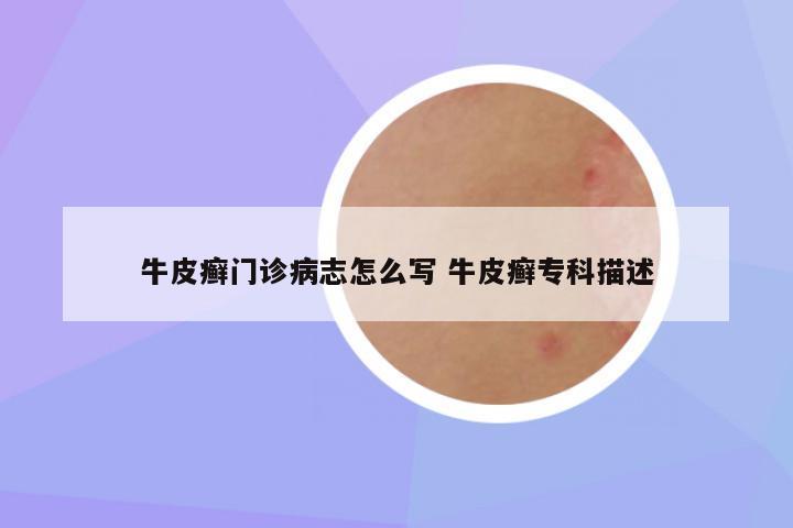 牛皮癣门诊病志怎么写 牛皮癣专科描述