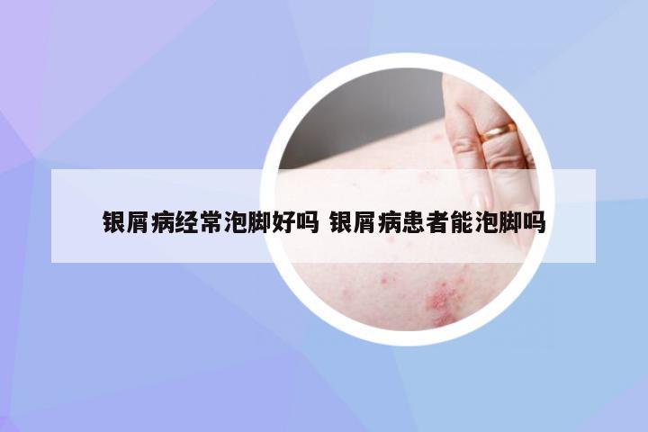 银屑病经常泡脚好吗 银屑病患者能泡脚吗