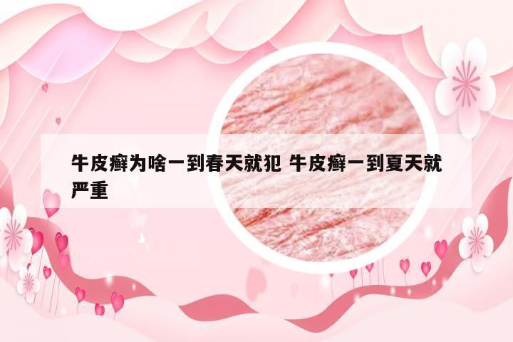 牛皮癣为啥一到春天就犯 牛皮癣一到夏天就严重