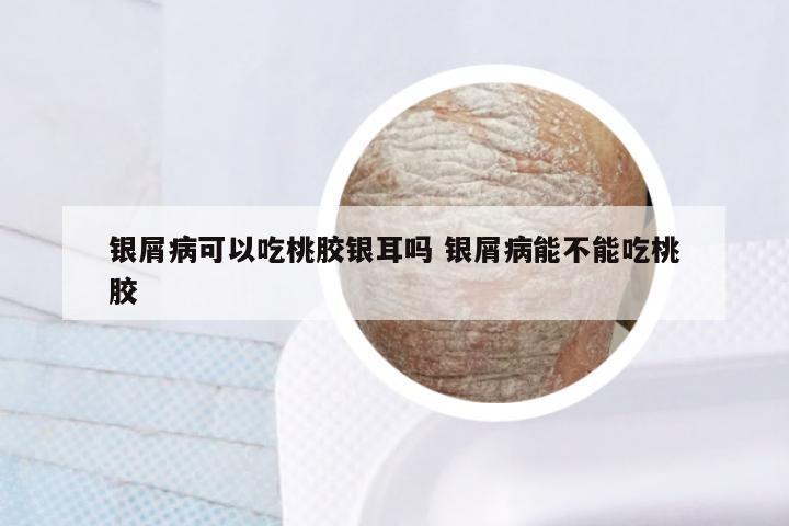 银屑病可以吃桃胶银耳吗 银屑病能不能吃桃胶