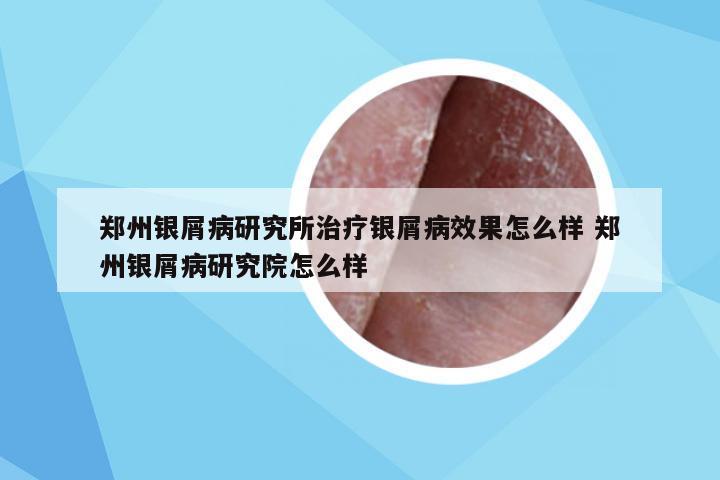 郑州银屑病研究所治疗银屑病效果怎么样 郑州银屑病研究院怎么样