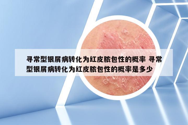寻常型银屑病转化为红皮脓包性的概率 寻常型银屑病转化为红皮脓包性的概率是多少