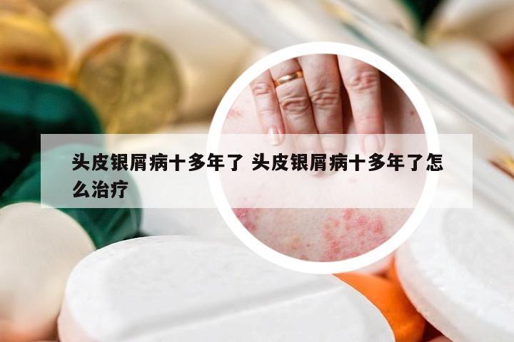 头皮银屑病十多年了 头皮银屑病十多年了怎么治疗