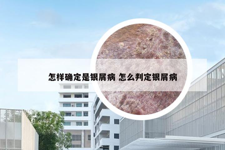 怎样确定是银屑病 怎么判定银屑病