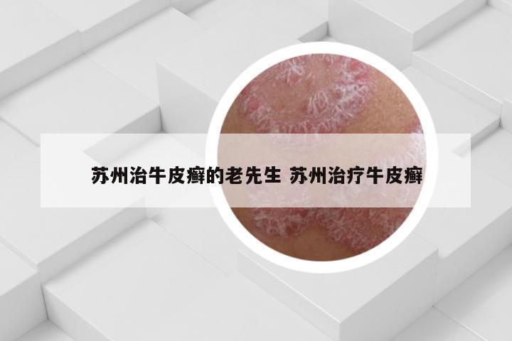 苏州治牛皮癣的老先生 苏州治疗牛皮癣