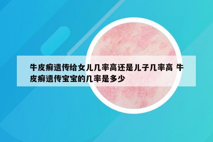 牛皮癣遗传给女儿几率高还是儿子几率高 牛皮癣遗传宝宝的几率是多少