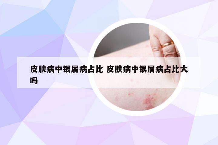 皮肤病中银屑病占比 皮肤病中银屑病占比大吗
