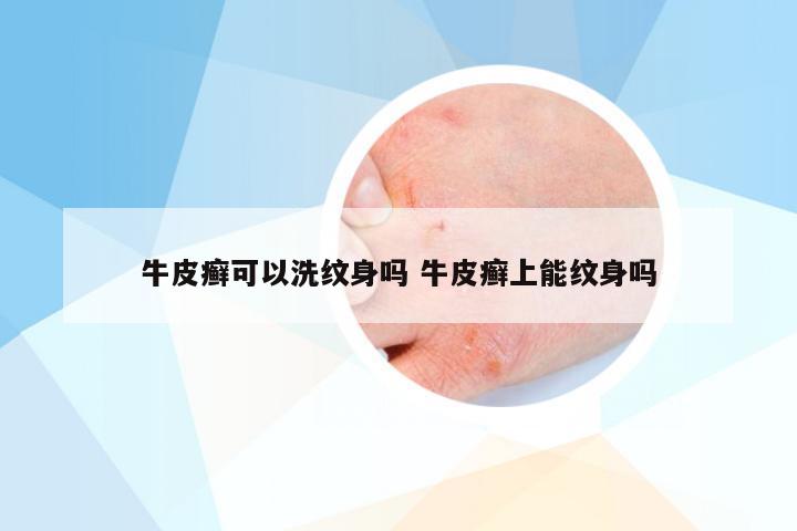 牛皮癣可以洗纹身吗 牛皮癣上能纹身吗