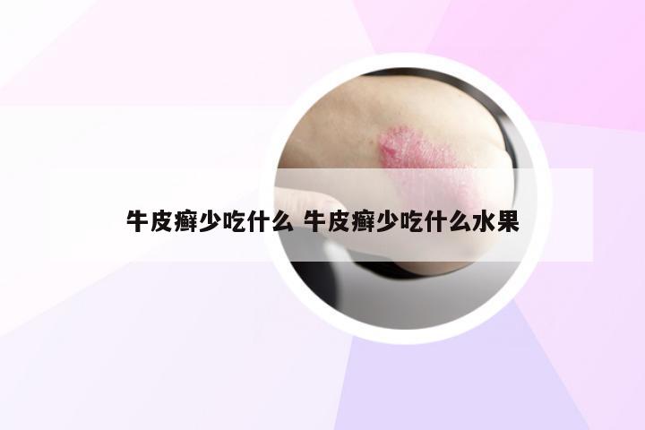 牛皮癣少吃什么 牛皮癣少吃什么水果