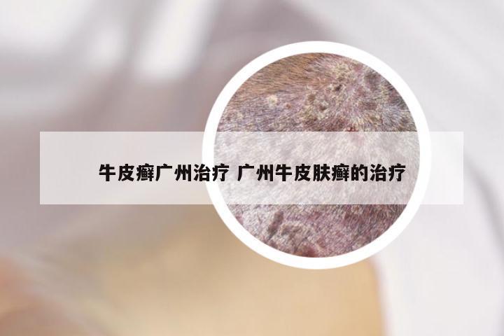 牛皮癣广州治疗 广州牛皮肤癣的治疗