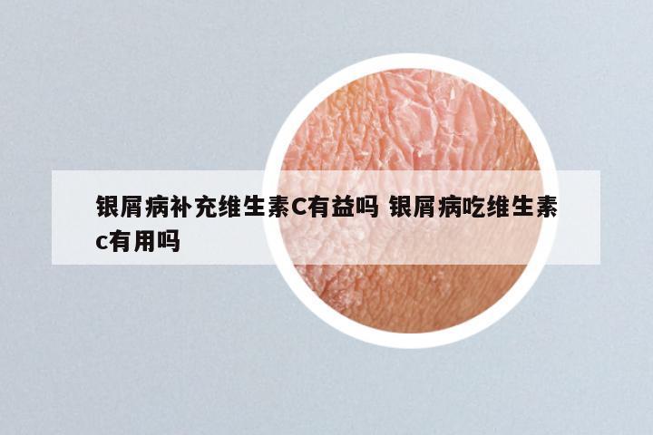 银屑病补充维生素C有益吗 银屑病吃维生素c有用吗