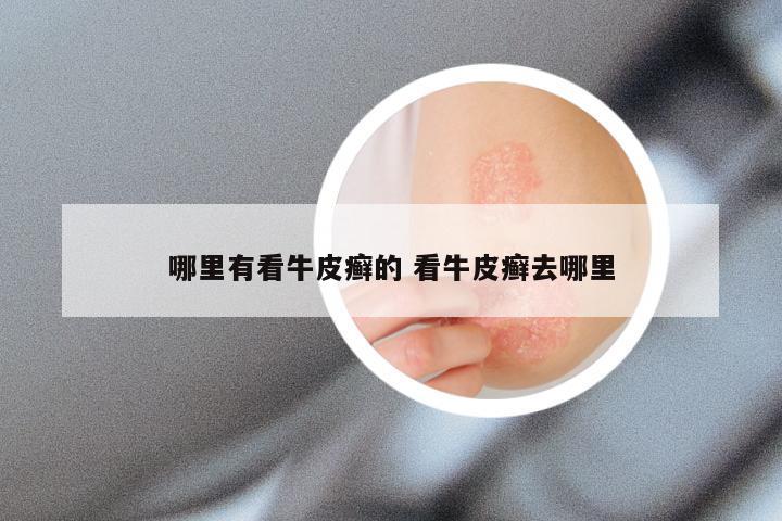 哪里有看牛皮癣的 看牛皮癣去哪里