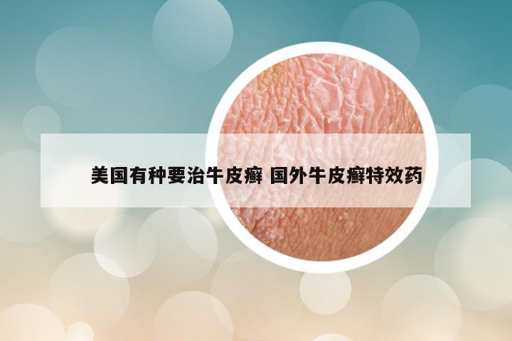美国有种要治牛皮癣 国外牛皮癣特效药