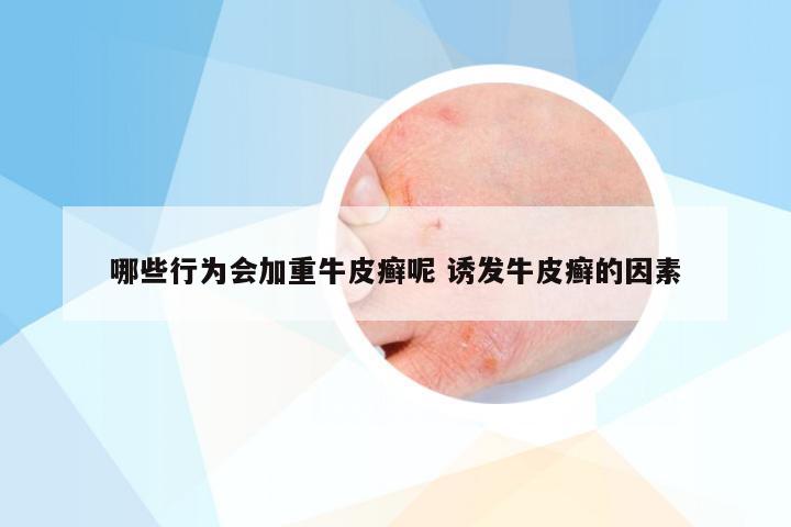 哪些行为会加重牛皮癣呢 诱发牛皮癣的因素