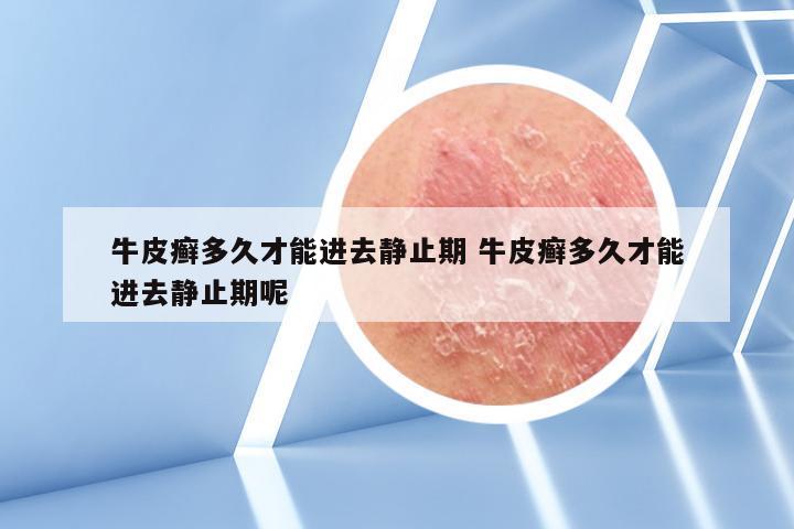 牛皮癣多久才能进去静止期 牛皮癣多久才能进去静止期呢