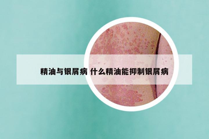 精油与银屑病 什么精油能抑制银屑病