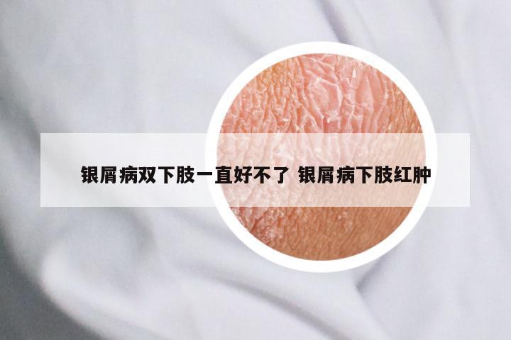 银屑病双下肢一直好不了 银屑病下肢红肿