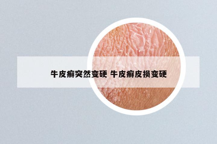 牛皮癣突然变硬 牛皮癣皮损变硬
