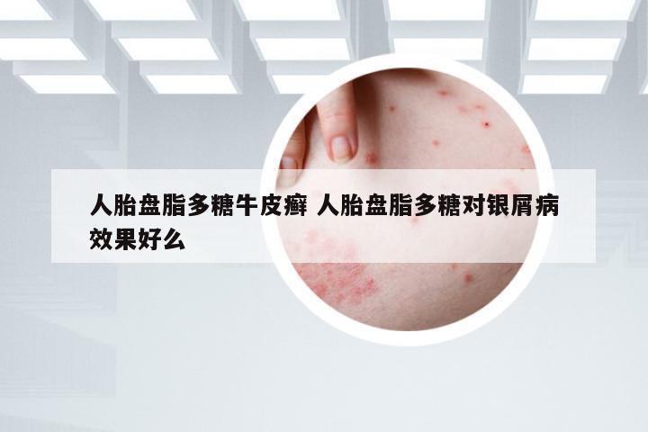 人胎盘脂多糖牛皮癣 人胎盘脂多糖对银屑病效果好么