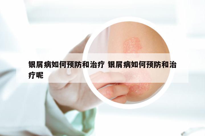 银屑病如何预防和治疗 银屑病如何预防和治疗呢