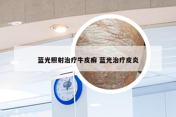 蓝光照射治疗牛皮癣 蓝光治疗皮炎
