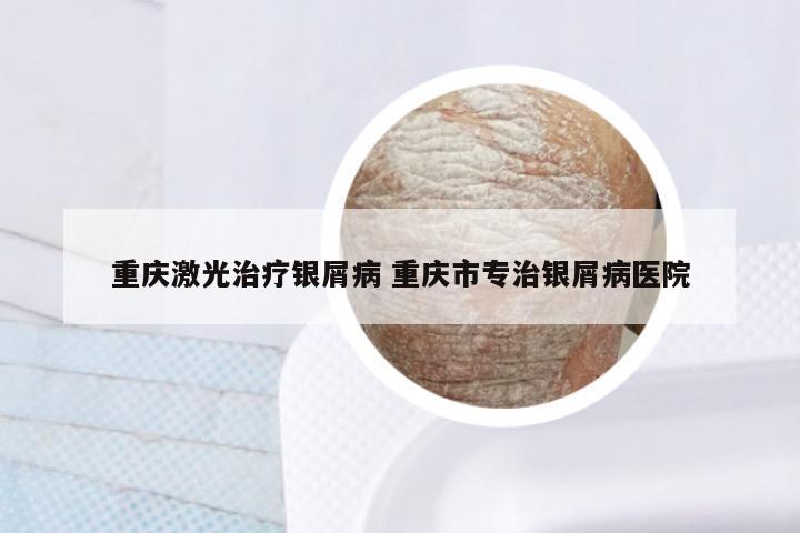 重庆激光治疗银屑病 重庆市专治银屑病医院