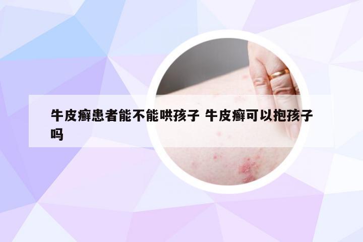 牛皮癣患者能不能哄孩子 牛皮癣可以抱孩子吗
