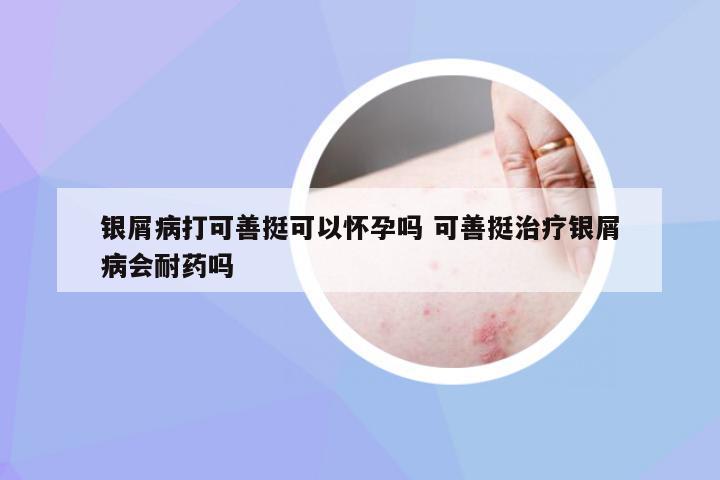 银屑病打可善挺可以怀孕吗 可善挺治疗银屑病会耐药吗