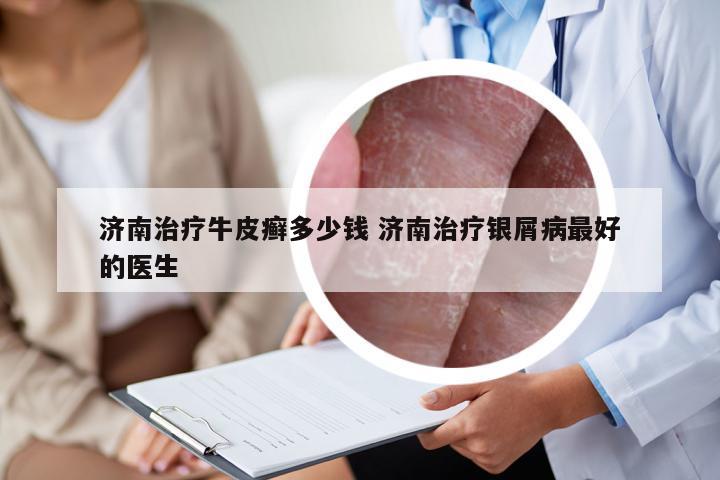 济南治疗牛皮癣多少钱 济南治疗银屑病最好的医生