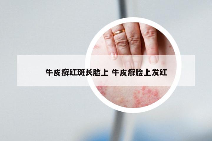 牛皮癣红斑长脸上 牛皮癣脸上发红
