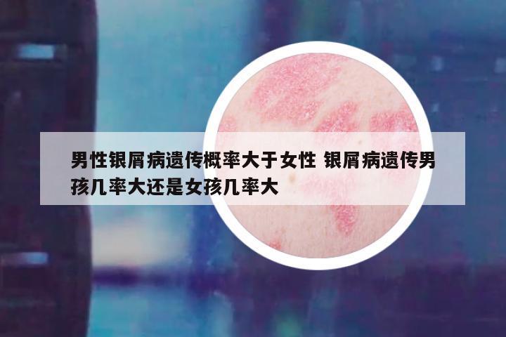 男性银屑病遗传概率大于女性 银屑病遗传男孩几率大还是女孩几率大