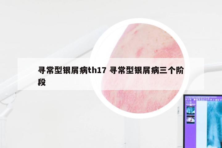 寻常型银屑病th17 寻常型银屑病三个阶段