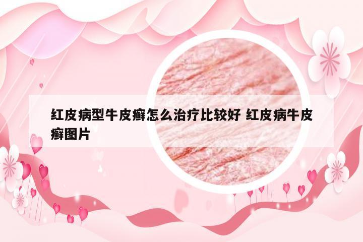 红皮病型牛皮癣怎么治疗比较好 红皮病牛皮癣图片