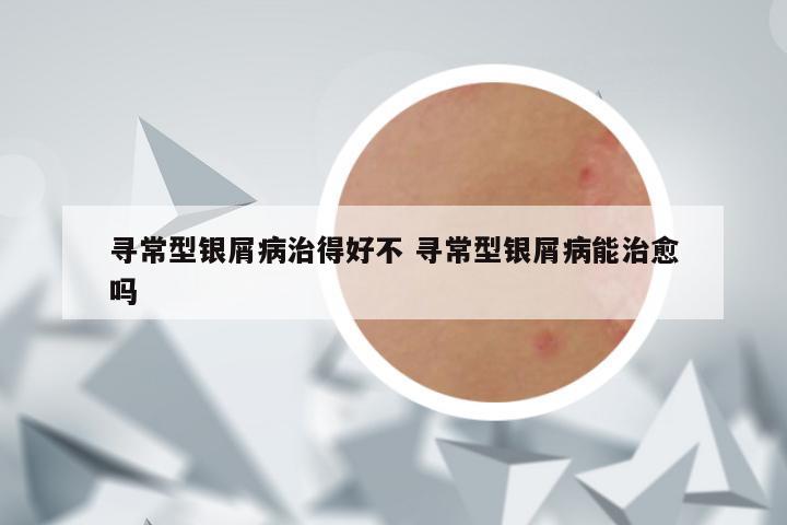 寻常型银屑病治得好不 寻常型银屑病能治愈吗