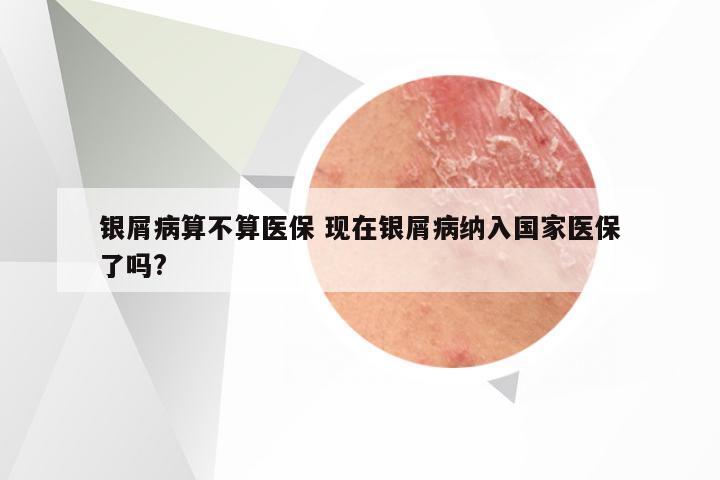 银屑病算不算医保 现在银屑病纳入国家医保了吗?