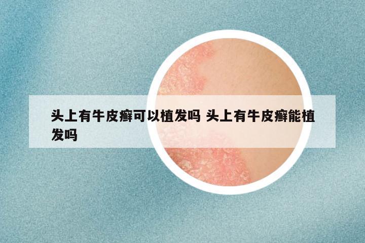 头上有牛皮癣可以植发吗 头上有牛皮癣能植发吗