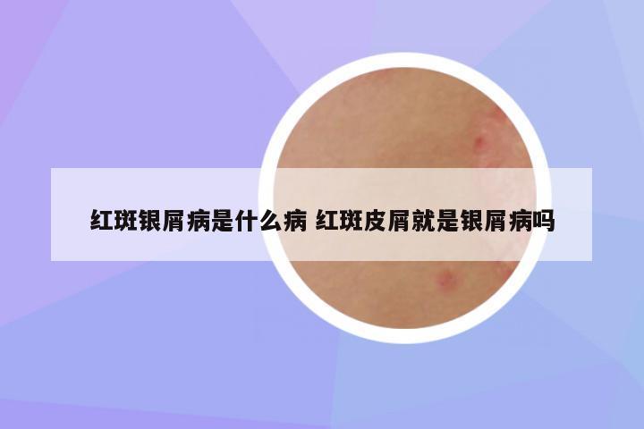 红斑银屑病是什么病 红斑皮屑就是银屑病吗