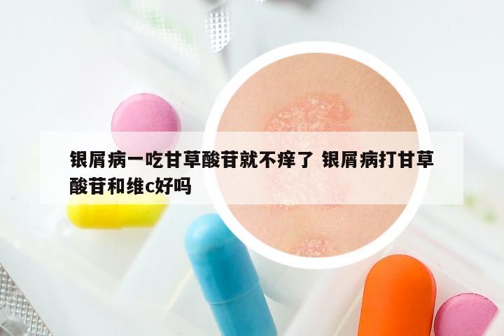 银屑病一吃甘草酸苷就不痒了 银屑病打甘草酸苷和维c好吗