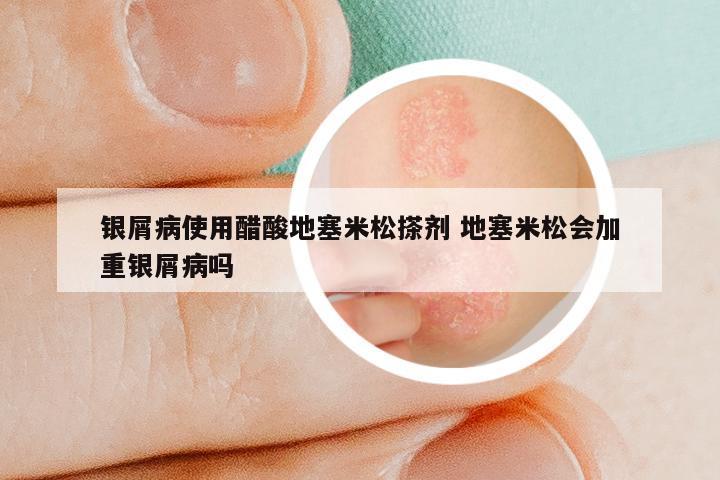 银屑病使用醋酸地塞米松搽剂 地塞米松会加重银屑病吗