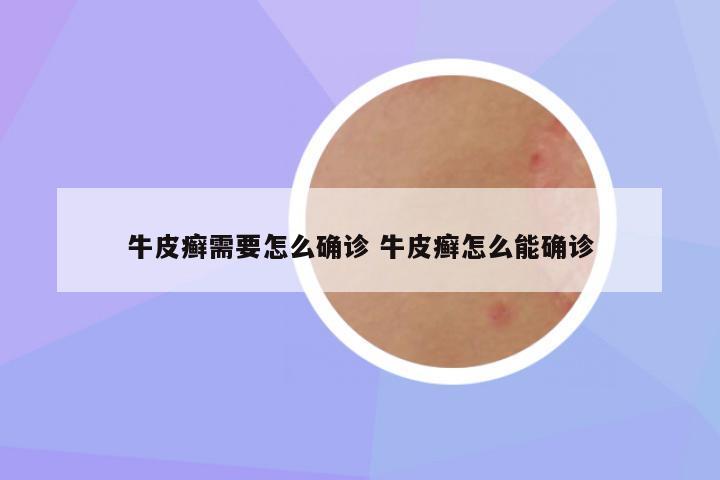 牛皮癣需要怎么确诊 牛皮癣怎么能确诊