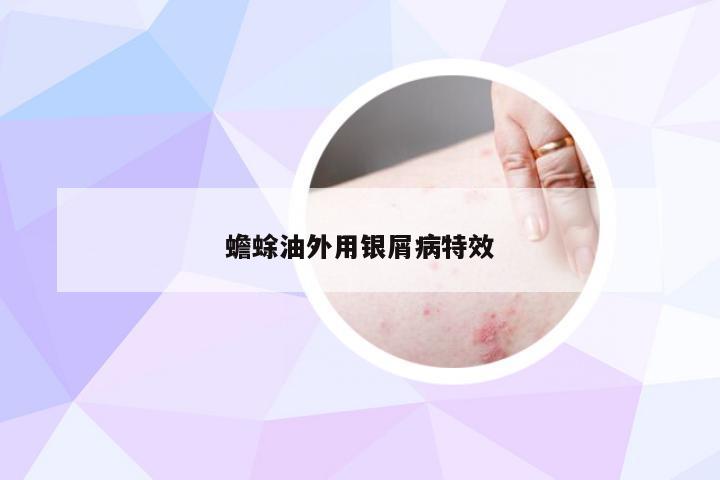 蟾蜍油外用银屑病特效