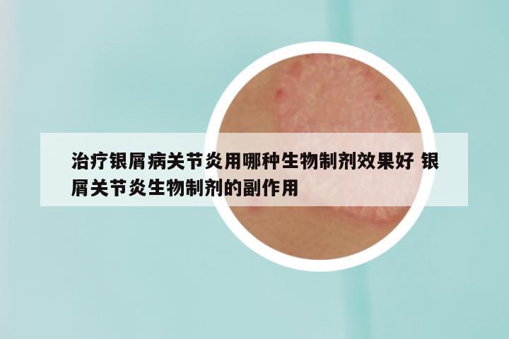 治疗银屑病关节炎用哪种生物制剂效果好 银屑关节炎生物制剂的副作用