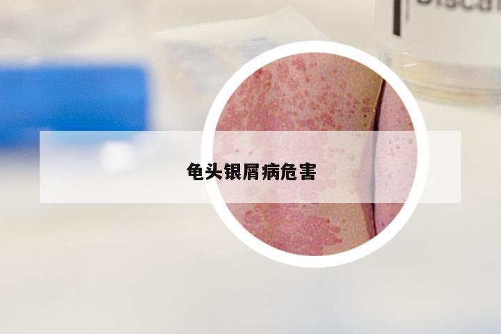 龟头银屑病危害
