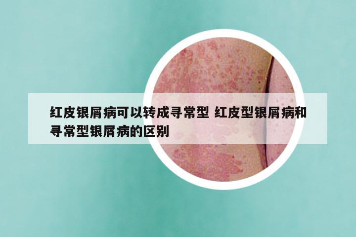 红皮银屑病可以转成寻常型 红皮型银屑病和寻常型银屑病的区别